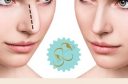 rinoplastika