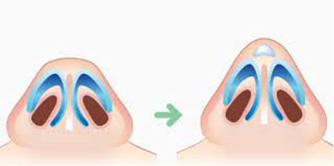 Rinoplastika-Tip (Burun Ucu Rinoplastikası), 