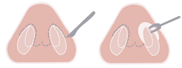 Qapalı rinoplastika əməliyyatı